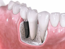 Dental Implants