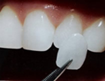 Porcelain Veneers